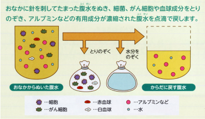 CART療法［腹水ろ過濃縮再静注法］（保険診療）